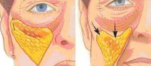 面部溶脂8.png 面部溶脂8.png