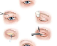 雙眼皮6.png 雙眼皮6.png