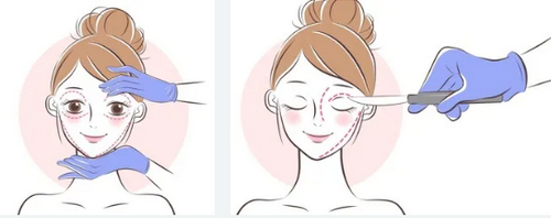 昆山百達麗做雙眼皮怎么樣？整形恢復(fù)過程出爐~主打真實