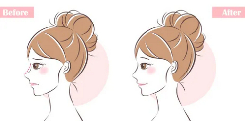 南寧膨體隆鼻多少錢？公布幾家熱門醫(yī)美醫(yī)院