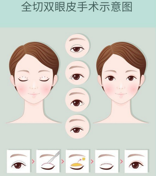 成都銅雀臺做雙眼皮技術怎么樣？幫你優(yōu)選醫(yī)生&真實案例反饋i