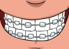 牙齒矯正19.png 牙齒矯正19.png