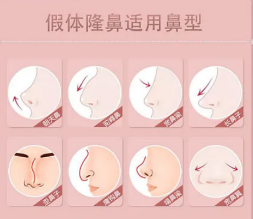 哈醫(yī)大四院整形美容科隆鼻護理需要做哪些，醫(yī)院信息公布出來啦~