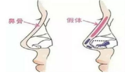 甘肅省人民醫(yī)院燒傷整形科隆鼻手術(shù)后怎么做好護理，醫(yī)院信息公布出來啦~