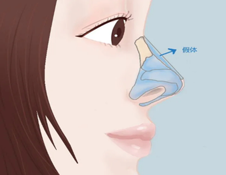 成都假體隆鼻手術(shù)要多少錢？隆鼻費用明細+醫(yī)院推薦