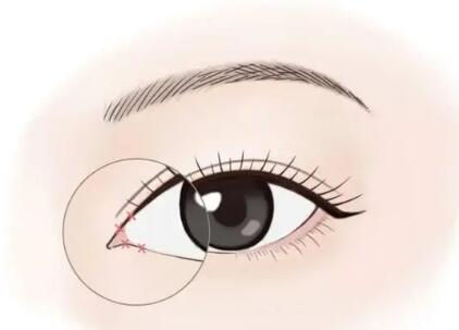 太原內(nèi)眼角修復(fù)價(jià)格是多少？前三醫(yī)院名單更新