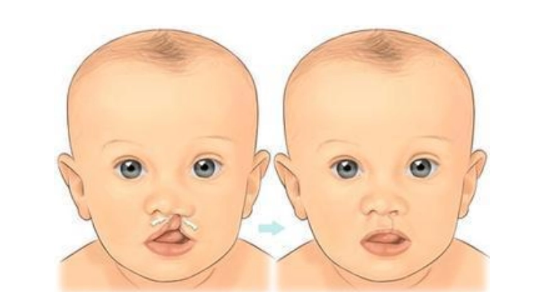 華西醫(yī)院唇腭裂專家介紹發(fā)布,4位好評(píng)醫(yī)生重磅揭曉