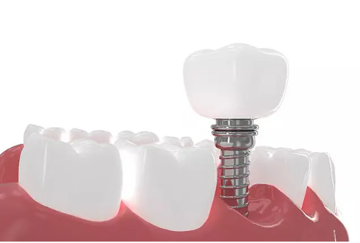 邯鄲牙齒種植需要多少錢(qián)?這三家牙科醫(yī)院很優(yōu)秀