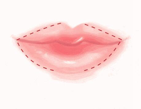 武漢唇部玻尿酸注射多少錢？推薦熱門人氣醫(yī)美醫(yī)院