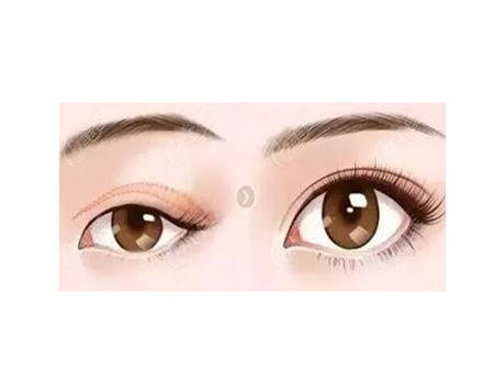 北京雙眼皮價格如何？價格咨詢盤點，附實力醫(yī)院名單