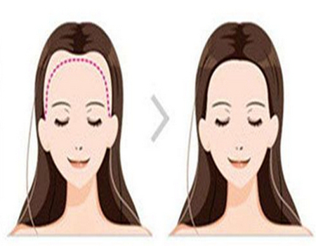 濰坊植發(fā)手術(shù)需要多少費(fèi)用？上榜醫(yī)院均是精選公立醫(yī)院