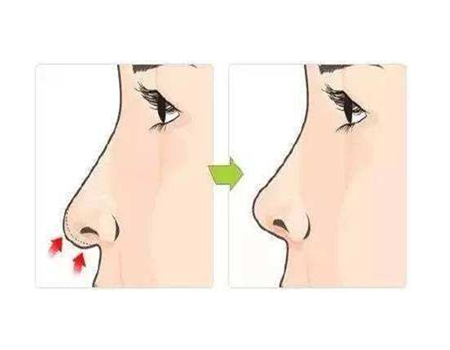 合肥隆鼻價格多少？隆鼻方法|醫(yī)院|醫(yī)生都是影響因素