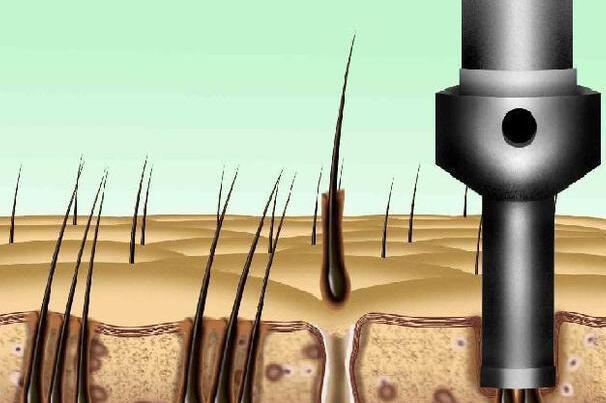 西安植發(fā)價(jià)格多少？精選3家推薦醫(yī)院