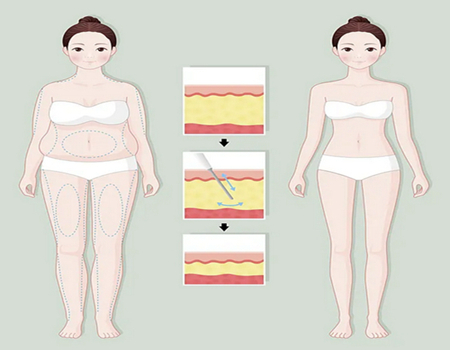 昆明吸脂多少錢？盤點口碑醫(yī)院基本信息