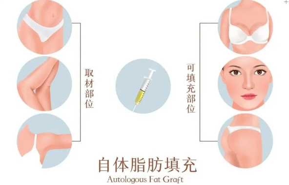 許昌市人民醫(yī)院整形美容科玻尿酸填充面部怎么樣？醫(yī)生技術(shù)能力強(qiáng)，效果自然