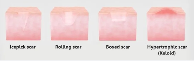 蘇州市立醫(yī)院北區(qū)燒傷整形科疤痕修復(fù)手術(shù)怎么樣？附帶真人案例和價格表