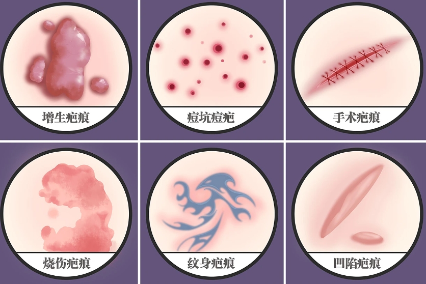 成都華西醫(yī)院祛疤怎么樣？醫(yī)院醫(yī)生技術(shù)好不好