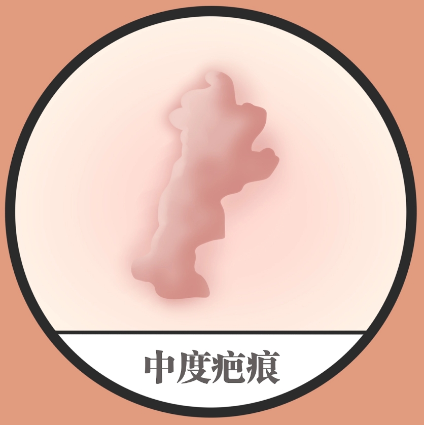 上海九院劉偉祛疤怎么樣？疤痕切除效果好嗎？疤痕修復(fù)案例一覽