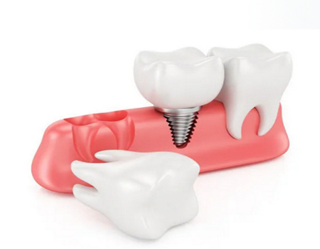 株洲做種植牙價格多少？口碑醫(yī)院在線一覽