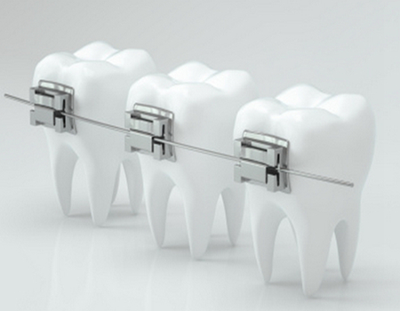 東莞矯正牙齒是多少？推薦3家實力在線的榜單