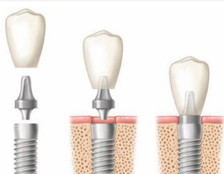 蘇州種植牙價格是多少？推薦醫(yī)院有蘇州附一、昆山中醫(yī)、蘇州附二