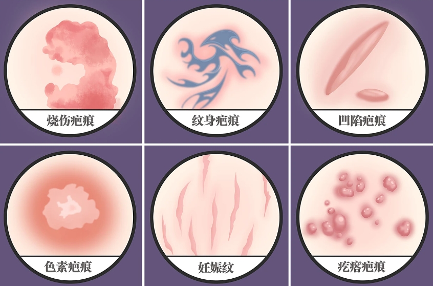 中國醫(yī)學(xué)科學(xué)院整形外科醫(yī)院王連召調(diào)節(jié)疤痕怎么樣？技術(shù)優(yōu)勢+案例