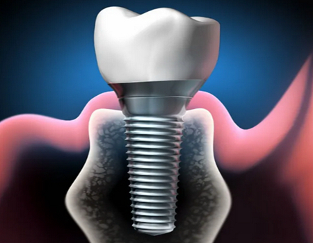 蘭州做種植牙價格多少錢？種植牙價格和醫(yī)生查詢！