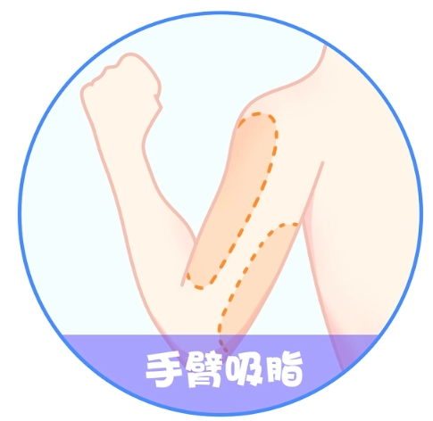 無錫手臂抽脂要多少錢?有哪些技術比較好的口碑醫(yī)院？