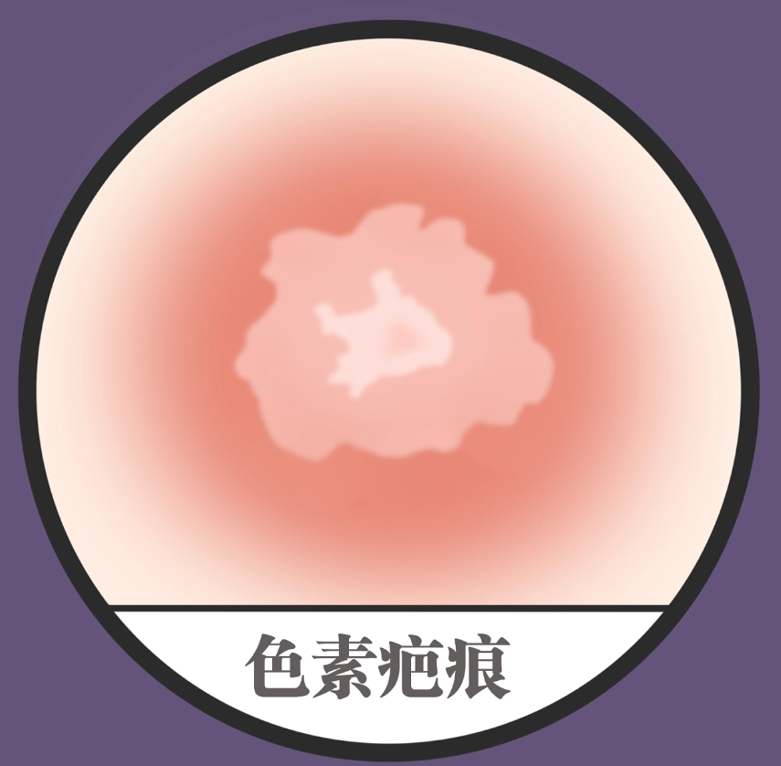 青島市城陽區(qū)人民醫(yī)院燒傷科疤痕手術介紹，內附2024費用參考真人案例詳情