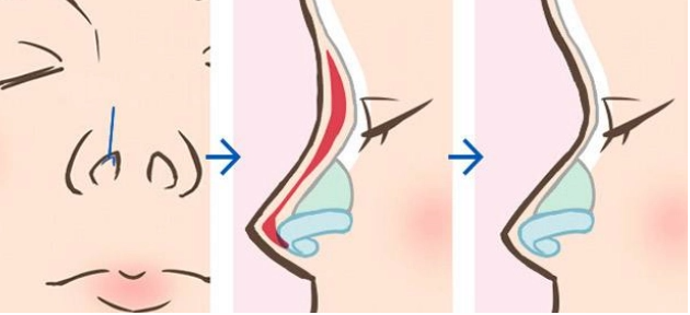 撫州市整形科假體隆鼻多少錢？案例回憶分享