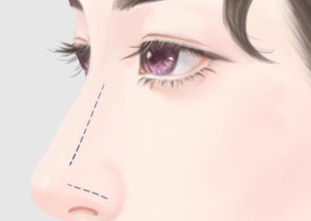 成都硅膠假體隆鼻手術(shù)價(jià)格貴不貴？新麗美、畫(huà)美以及現(xiàn)代整形一一上榜