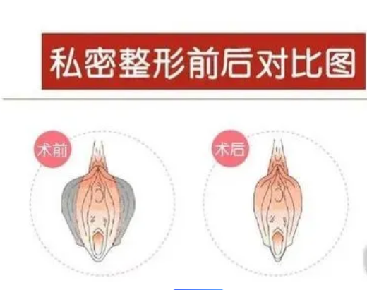 北京私密緊縮手術(shù)大概多少錢?三家醫(yī)院口碑爆棚，讓你安心變美！