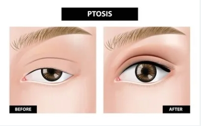中國醫(yī)學(xué)科學(xué)院整形外科醫(yī)院于曉波醫(yī)生做雙眼皮怎么樣？術(shù)后效果反饋