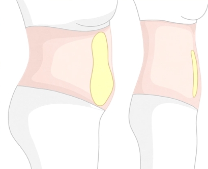 河南中醫(yī)一附院美容科吸脂多少錢?醫(yī)生靠譜,塑造苗條身材不煩惱