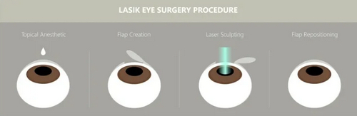 簡陽市人民醫(yī)院眼科近視手術(shù)價(jià)格高嗎？優(yōu)質(zhì)醫(yī)生幫助你摘掉眼鏡~