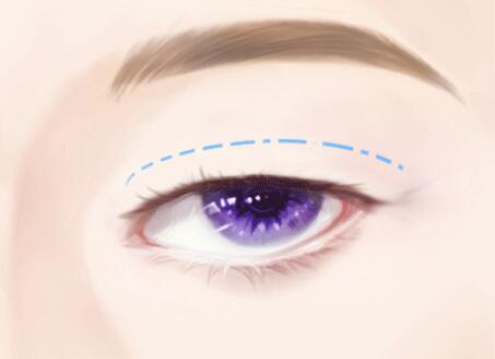 重慶雙眼皮修復價格多少？費用貴嗎？修復醫(yī)院名單在線看