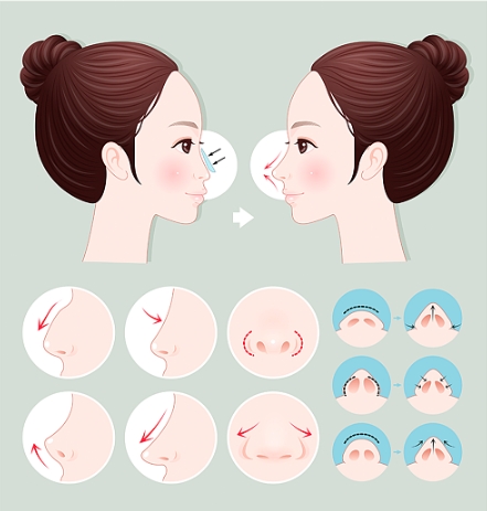 上海九院整形科李圣利醫(yī)生做鼻子審美怎么樣？醫(yī)生信息以及隆鼻案例一覽