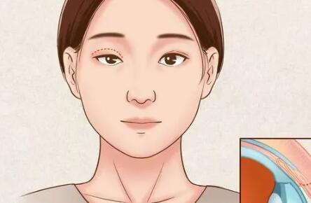 杭州做雙眼皮價格？參考價格|醫(yī)院名單分享