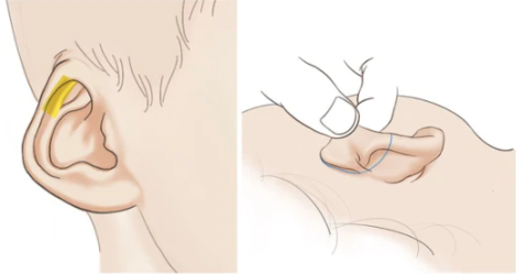 上海九院張群耳朵整形怎么樣?口碑怎么樣?耳畸形案例效果參考
