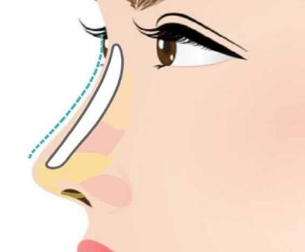 武漢駝峰鼻矯正手術價格是多少？全新盤點醫(yī)院排名