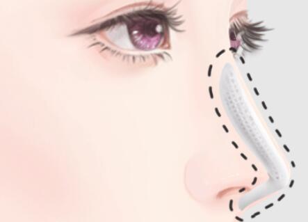 深圳做隆鼻價格多少？隆鼻醫(yī)院名單來襲