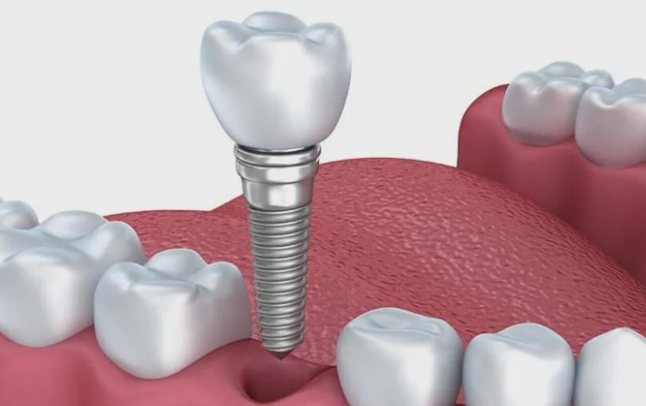 武漢種牙齒一顆要多少錢?種植牙哪家口腔醫(yī)院好