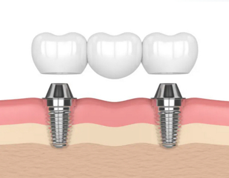 南昌做種植牙價格多少？甄選top3醫(yī)院詳情