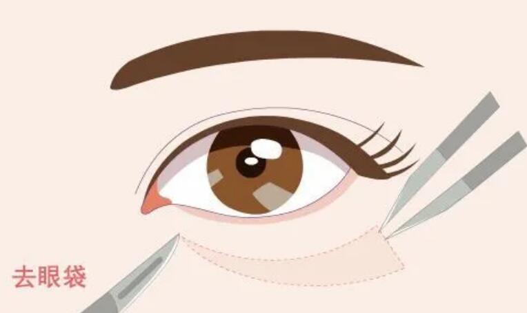 惠州割眼袋費用大概多少錢?口碑公立醫(yī)院均上榜