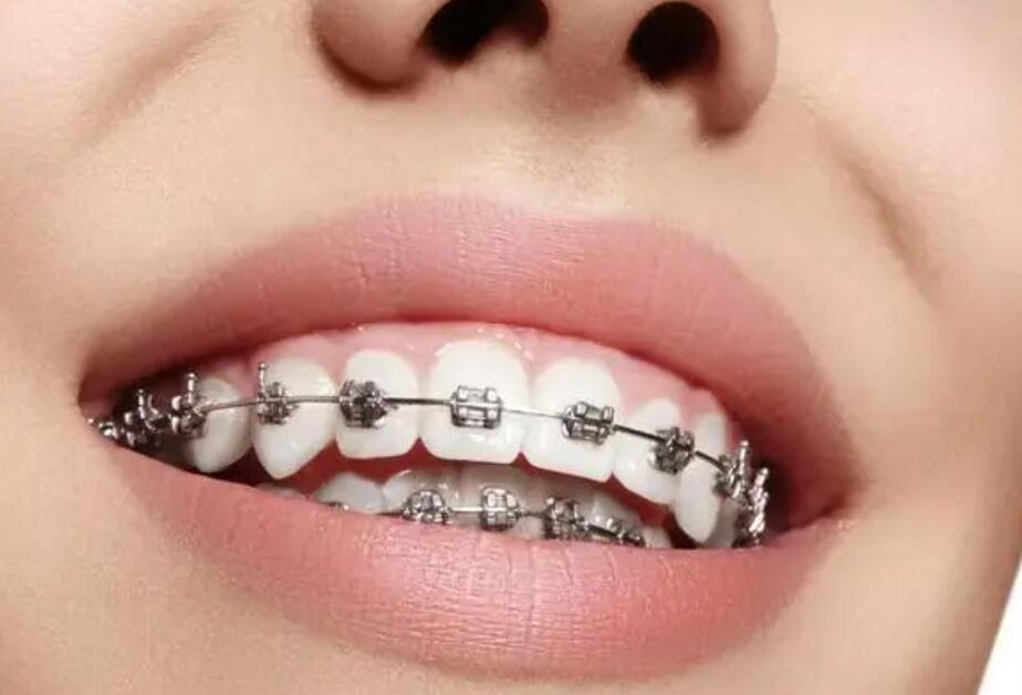 珠海牙齒矯正費用大概多少?三家專業(yè)公立醫(yī)院口腔科解讀