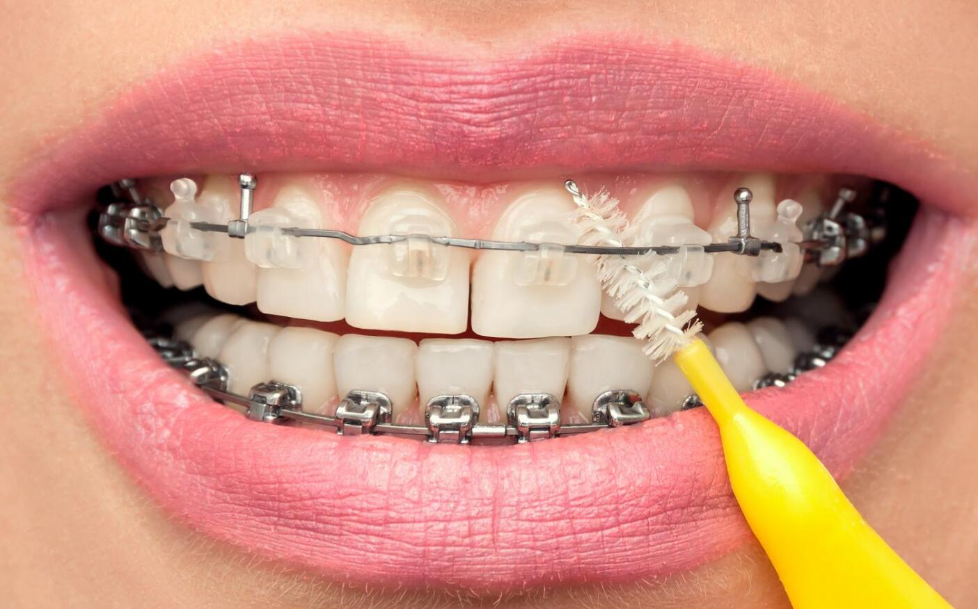 臺州牙齒正畸費用一般多少?實力口腔醫(yī)院千萬別錯過