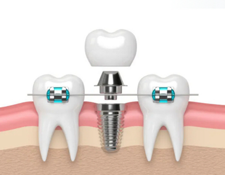 揚(yáng)州做種植牙價(jià)格多少？點(diǎn)擊了解相關(guān)的醫(yī)院簡(jiǎn)介