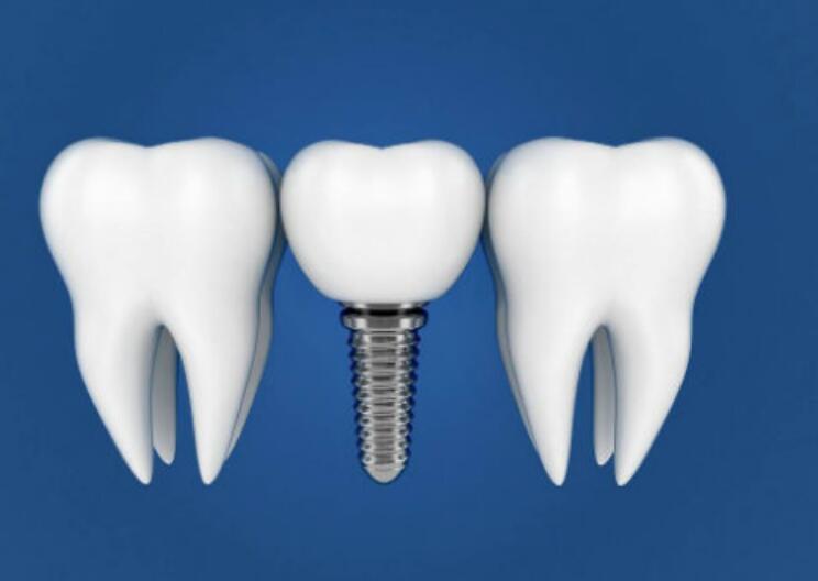 紹興全口種植牙齒一般需要多少錢？人氣牙科醫(yī)院都在這兒