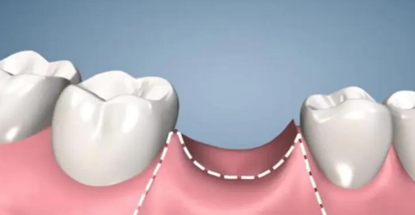 煙臺種植牙多少錢一顆價格表公布,專業(yè)靠譜的三家口腔醫(yī)院測評