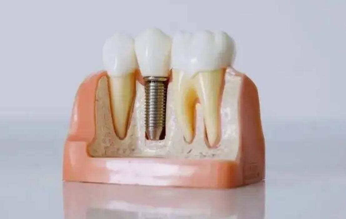 汕頭種植牙一顆大概多少錢?人氣醫(yī)院整理這下不用愁了